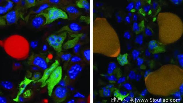 健康｜癌症变肥肉！科学家成功将癌细胞变成脂肪细胞