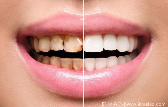 牙龈经常出血，这些口腔问题不注意，易患口腔疾病