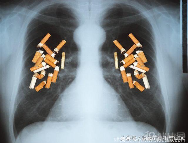 医生直言：这种肺癌很“棘手”，只有2种方法可以治疗