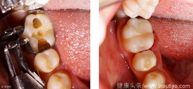 牙齿有这几个表现，说明你的牙齿正在衰老！