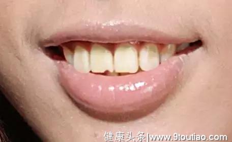 怎样把牙齿变的洁白光泽？