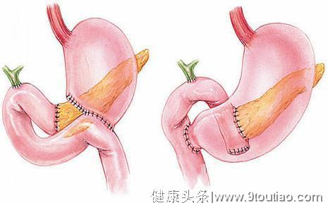 胃癌手术后，病人问我可以吃炸鸡吗？