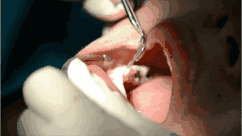 看牙医，有哪些操作可能会被感染肝炎？一定得自己防范着！