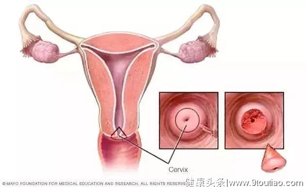 [女性健康] 早发现、可预防的癌症——宫颈癌