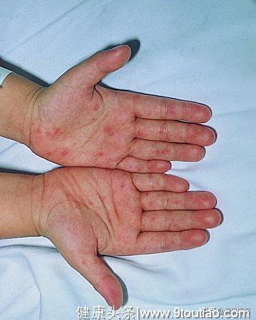 宝宝手足口，科学预防与护理的7个回答