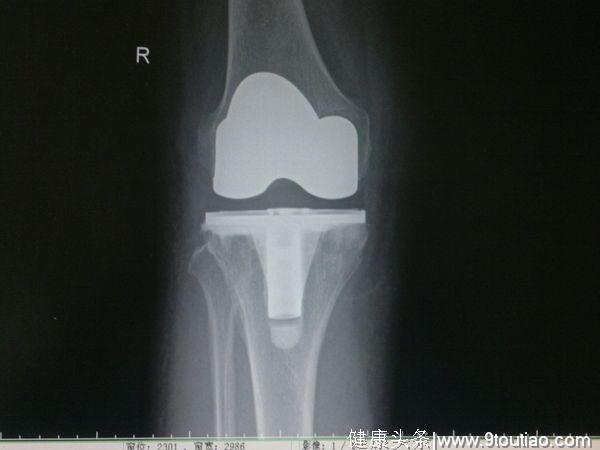有关膝关节骨性关节炎的科普，最常见的致残原因！