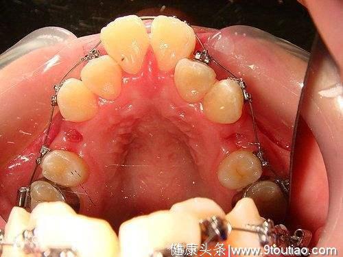 牙齿矫正需要拔几颗牙？