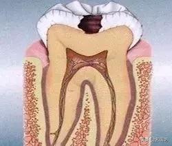 为什么牙齿不齐的人更容易长小黑点