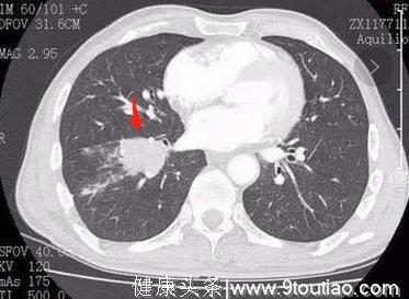 小细胞肺癌像水泥浆一样难缠，生存期3个月到5年，差异原因在哪？