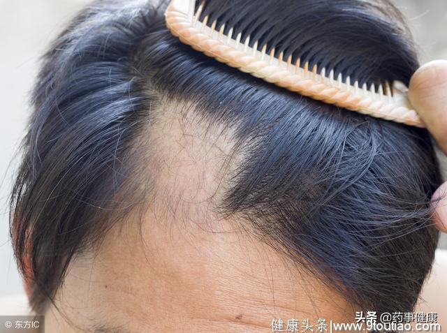 中国脱发人群约为2.5亿，30岁左右发展最快，秃如其来究竟为何？