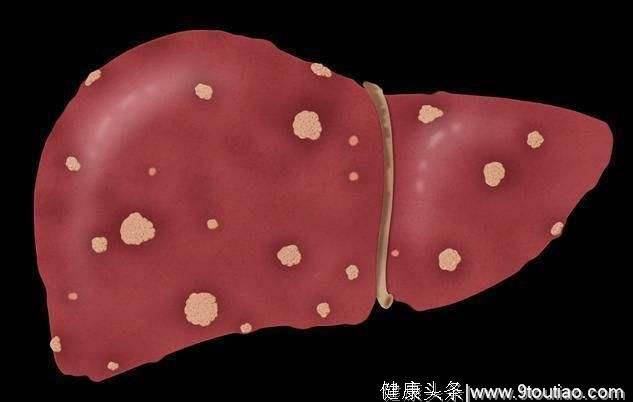 中国肝癌发病变化及2030年预测