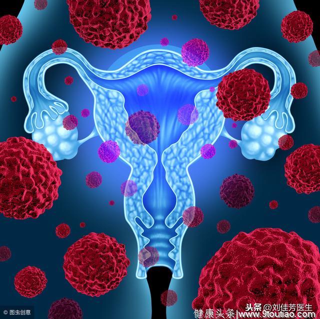宫颈癌早期，子宫发来的4个信号，你可以没有但是必须得懂