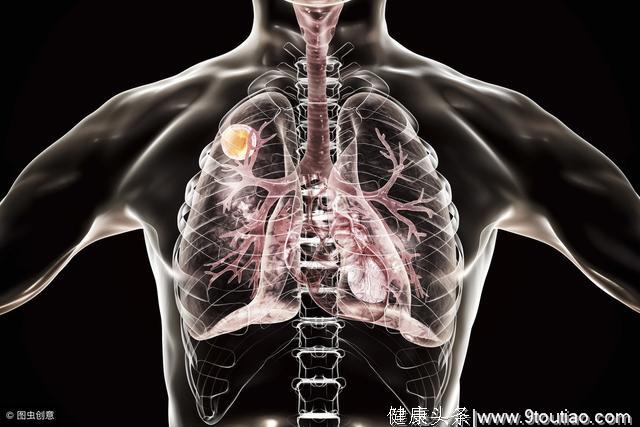 身体3个部位若“发黑”，是肺癌在敲门，最好去查下肺CT