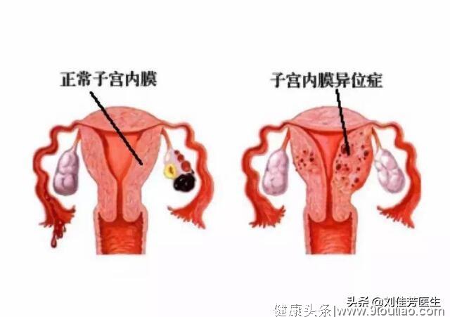子宫内膜异位的4个征兆，看看你的子宫，摆正位置了吗？