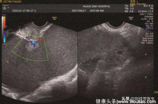 子宫内膜异位的4个征兆，看看你的子宫，摆正位置了吗？