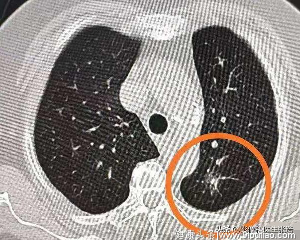 肺内发现磨玻璃结节，一定就是早期肺癌吗？