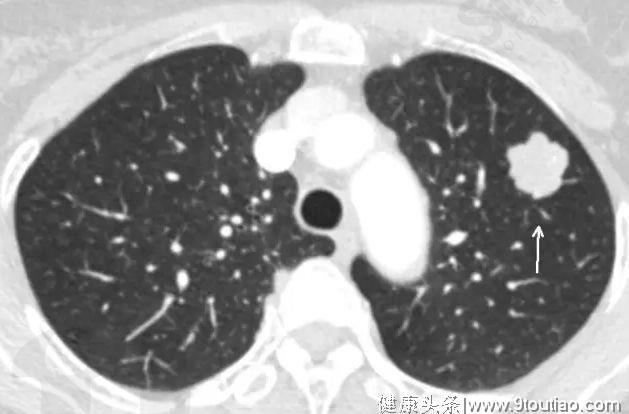 肺结节不可小视，若出现这3种情况，很容易变肺癌