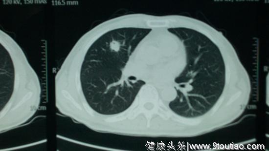 25岁小伙确诊肺癌，医生提醒：身体“一处”疼痛，或许肺已癌变！