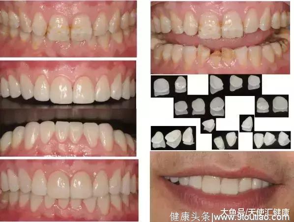 牙齿有缺陷，笑不出？超薄瓷贴面美学修复，重现美丽自信的笑容