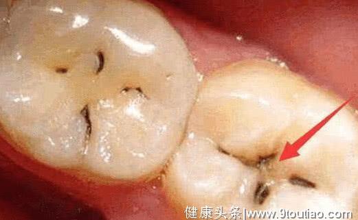 牙齿上长“黑线”是什么？如何清理，美女牙医：教你一招变洁白！