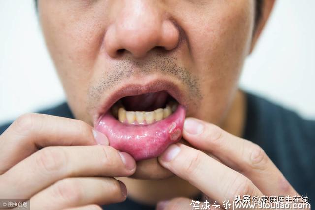口腔溃疡是小病？处理不好也麻烦，5个方法“治住”它