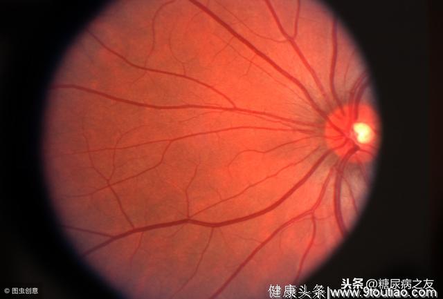 55岁，患糖尿病15年，视力开始下降，糖尿病患者到底应如何保护双眼