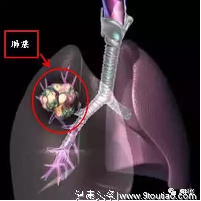 肺癌什么情况下能手术？专科医生告诉您评判标准！