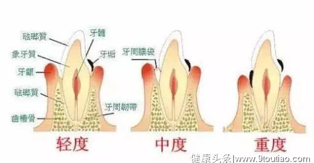 牙龈萎缩并不是口腔疾病的一种！