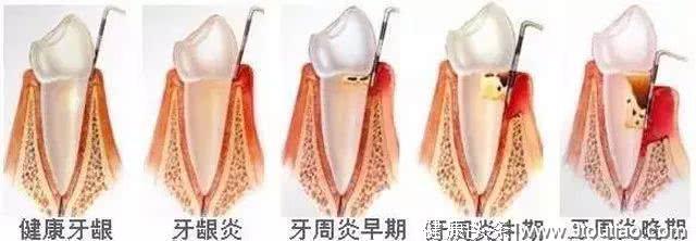 牙龈萎缩并不是口腔疾病的一种！
