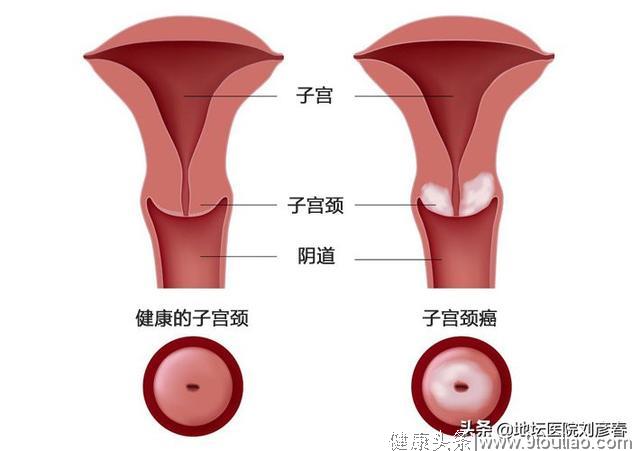 宫颈是子宫的保护伞！专家提醒：不想患上妇科病，这3事要做好
