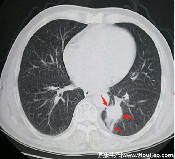肺癌的早期信号有哪几个？
