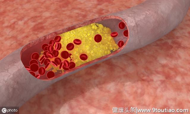 冠心病是由于胆固醇偏高导致的吗？医生带你了解真相