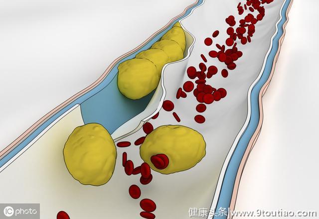 冠心病是由于胆固醇偏高导致的吗？医生带你了解真相