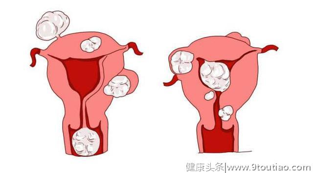 子宫肌瘤能不能怀孕，怀孕发现子宫肌瘤怎么办？