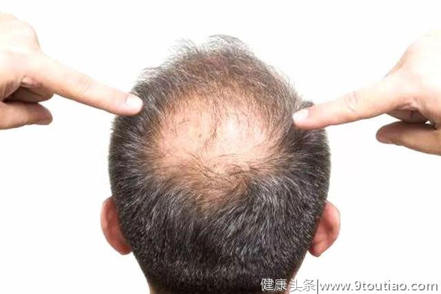 脂溢性脱发分为五种证型，治疗要遵医嘱辨证进行