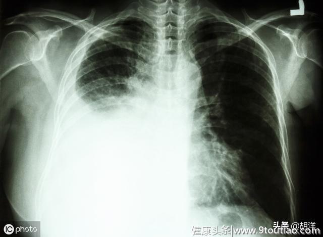 有些长的很像肺结核的肺病，一旦误诊后果严重，可能失去根治机会