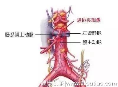 17岁小姐姐减肥减得尿血，“胡桃夹综合征”了解一下