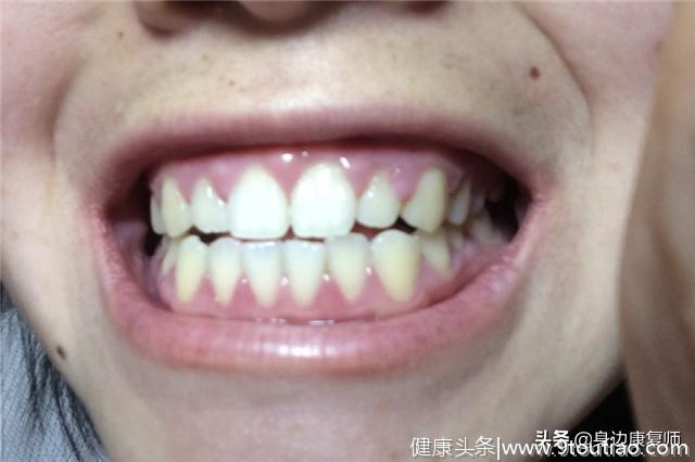 想要开口大笑，却不想被牙黄所影响，这些中药方法帮您美白牙齿