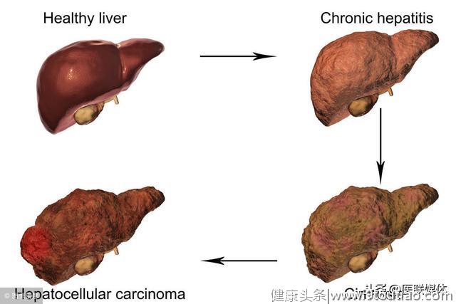 肝硬化腹水了，还有多少日子可活？医生给了一个准话