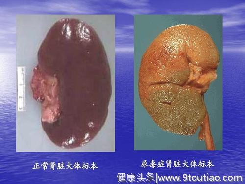 每1.5秒就有一个人发生尿毒症，糖尿病或成为尿毒症最大的后备军