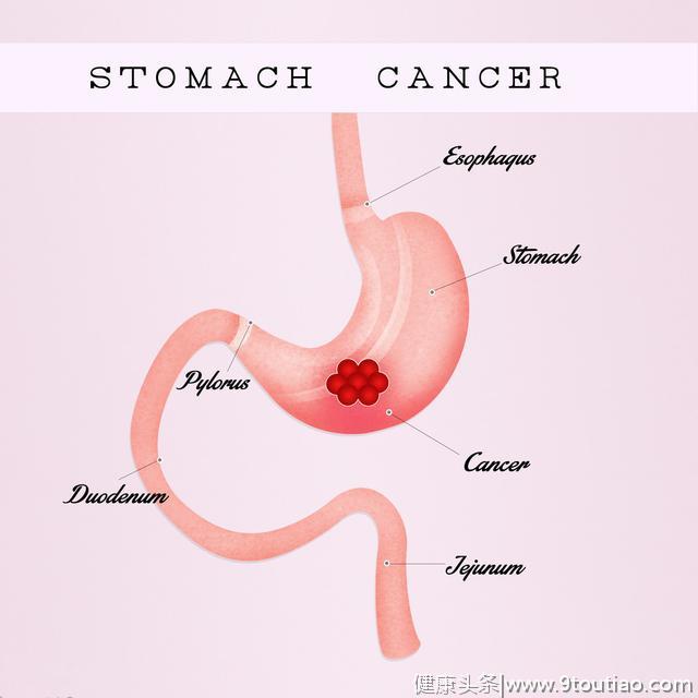 关于胃癌认识的误区