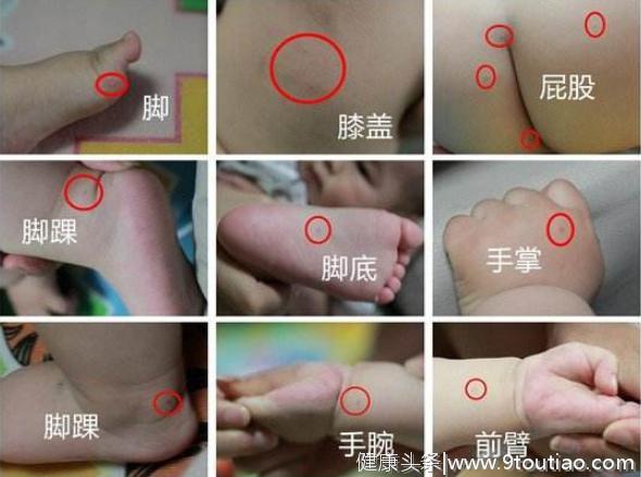 因“手足口”被幼儿园劝退，3-6岁幼儿如何预防手足口？