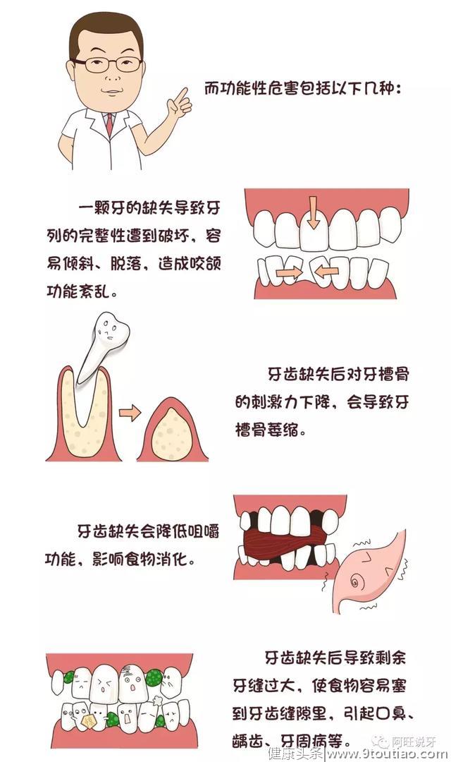 口腔常识手册之——牙齿缺失