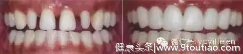 Helen齿科中心—— 烤瓷牙能终身使用吗？