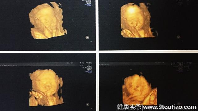怀孕6个月做四维，胎儿不停做鬼脸，逗乐了准爸妈，医生让堕胎