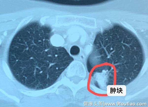 晚期肺癌的患者为什么总是发烧，该怎么办？