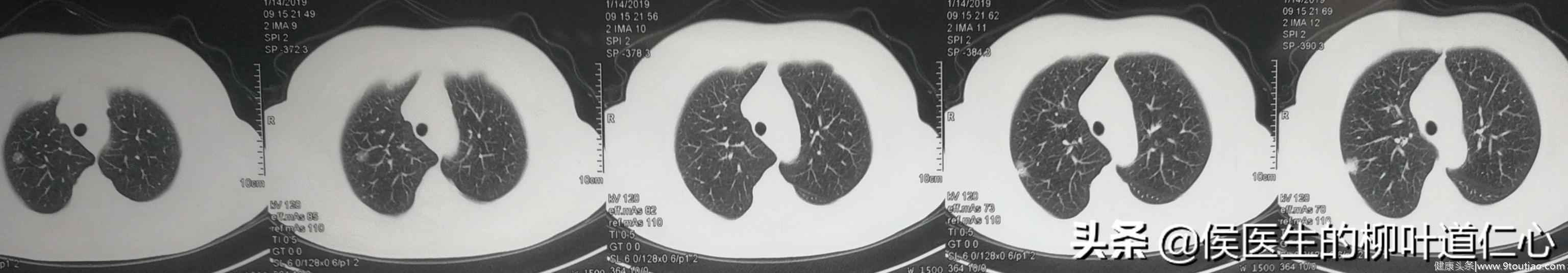 Ia1期“微小肺癌”术后，复发和转移的“锅”，谁来背？