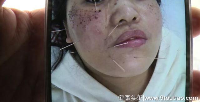 女子突然面瘫与脸上的斑有关 整形医院却说：这是感冒造成的