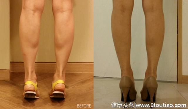 肌肉型和脂肪型的小腿分别要怎么瘦下来？
