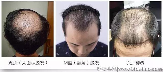 遗传性脱发、秃顶，到底怎么治？ 看了这些你就全明白了
